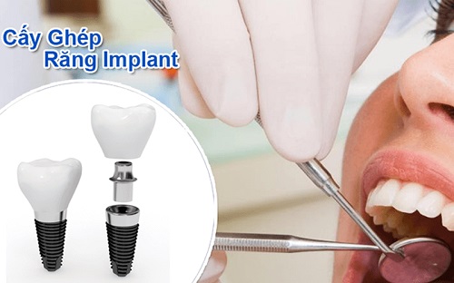 top-10-dia-chi-trong-rang-implant-uy-tin-nhat-tai-tphcm-12