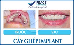 Top 10 địa chỉ trồng răng Implant tại TPHCM giá rẻ, uy tín